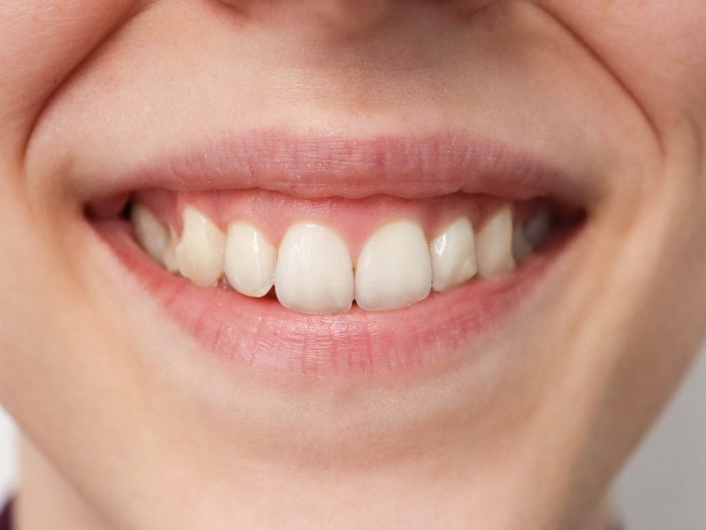 Invisalign