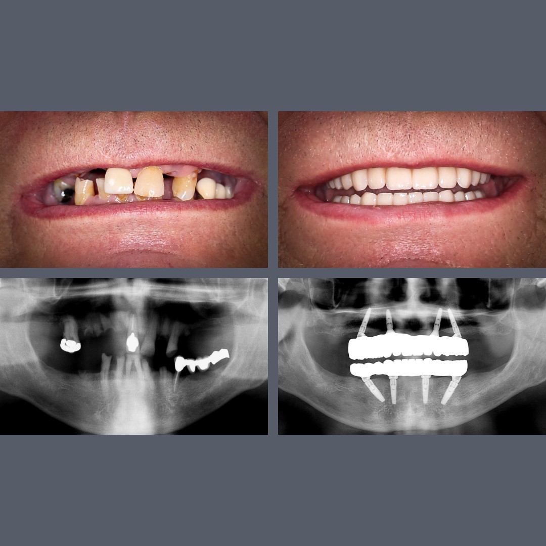 All-on-4® implantáció előtte-utána