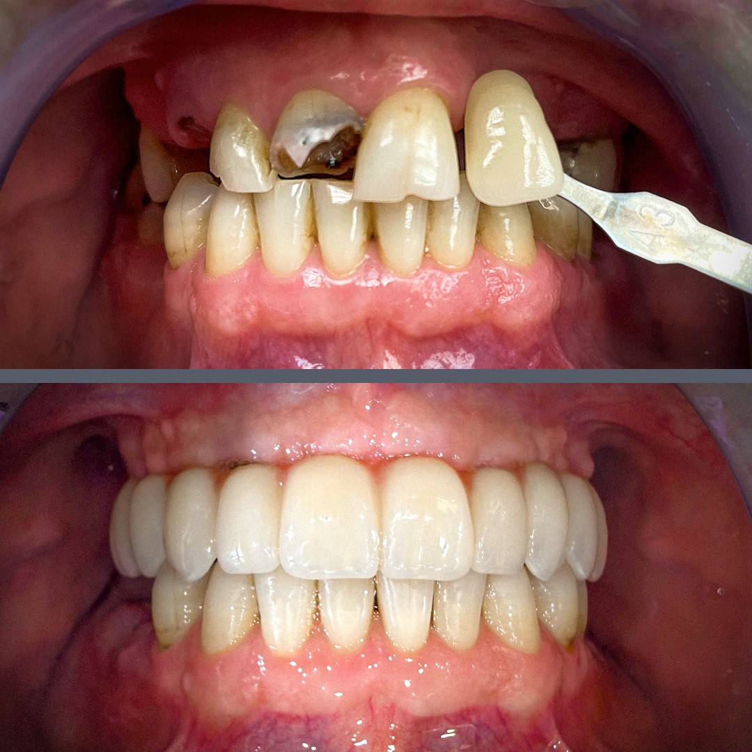 Felső All-on-4® és alsó implantátumos korona és híd