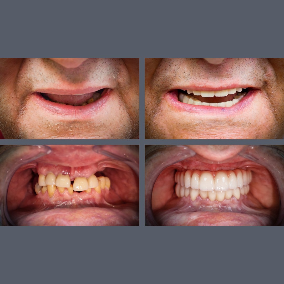 All-on-4 fogpótlás előtte-utána