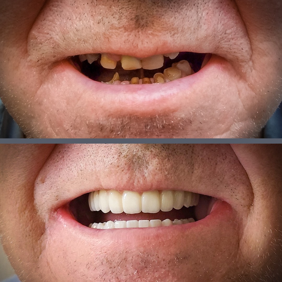 Alsó-felső All-on-4