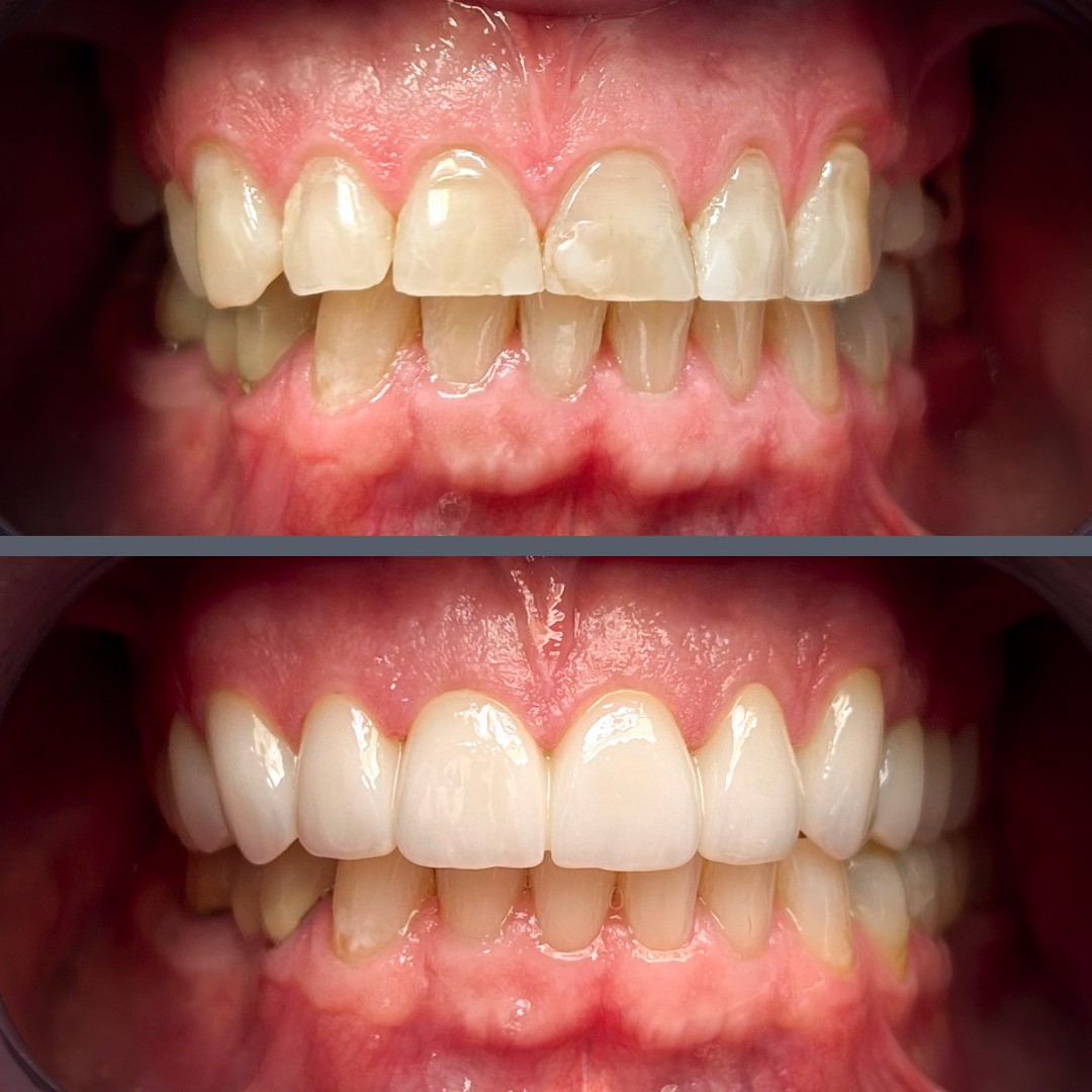 alsó felső cirkónium híd