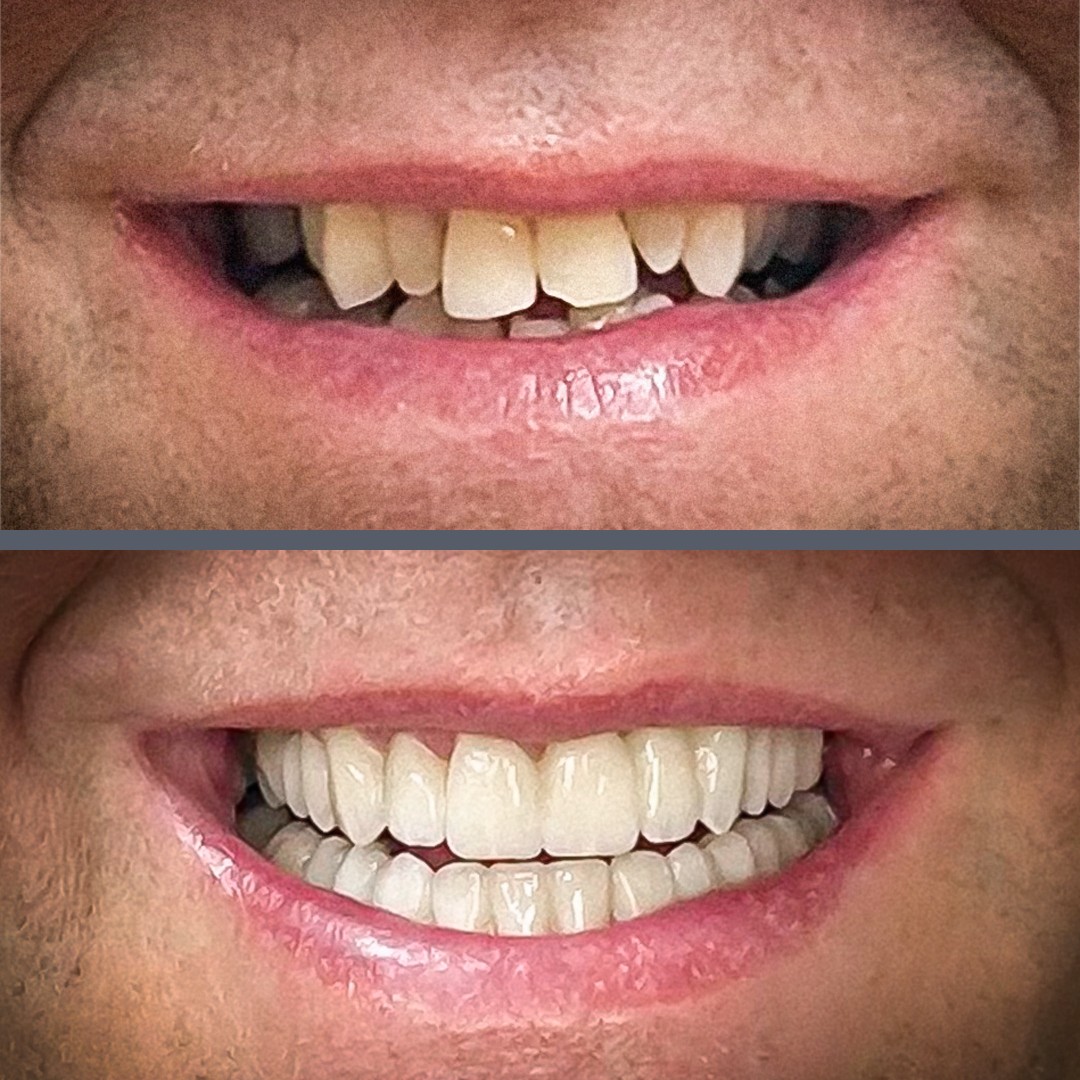 fogkorona előtte utána​