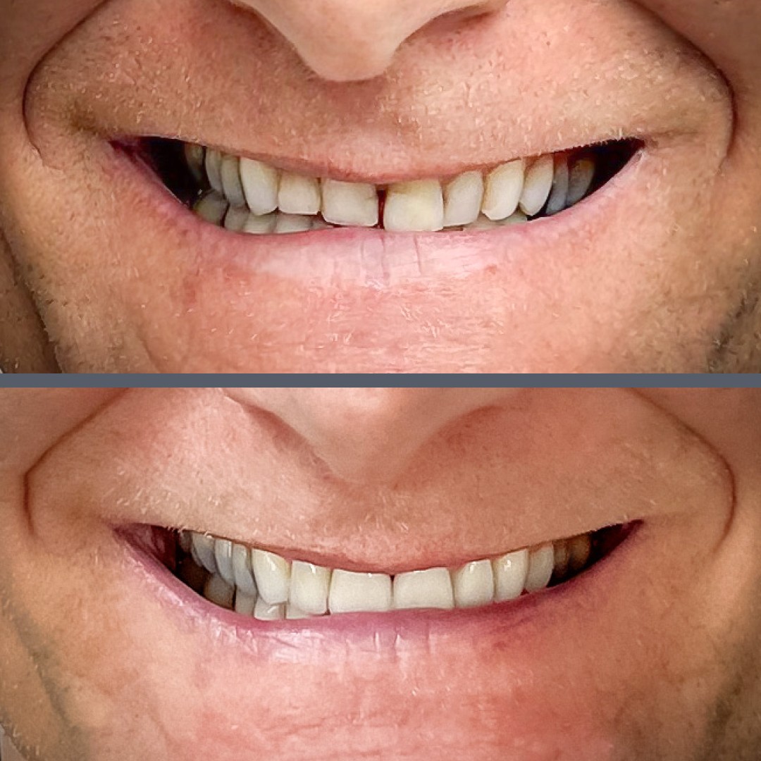 cirkónium korona előtte utána​