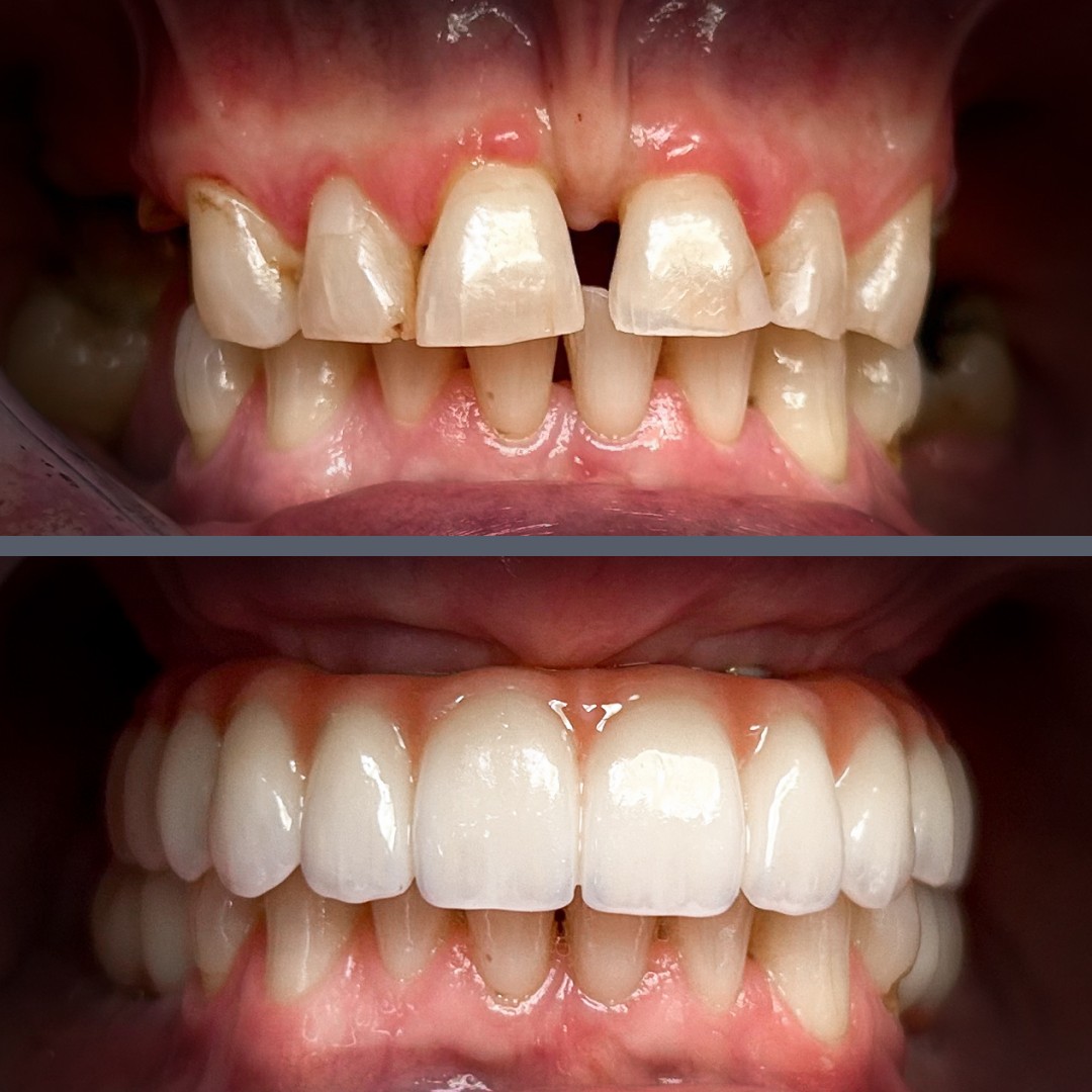 teljes felső fogsor all on 4 előtte utána