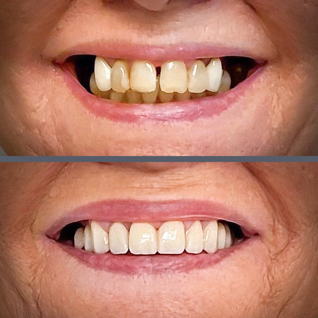 új mosoly előtte utána körhiddal